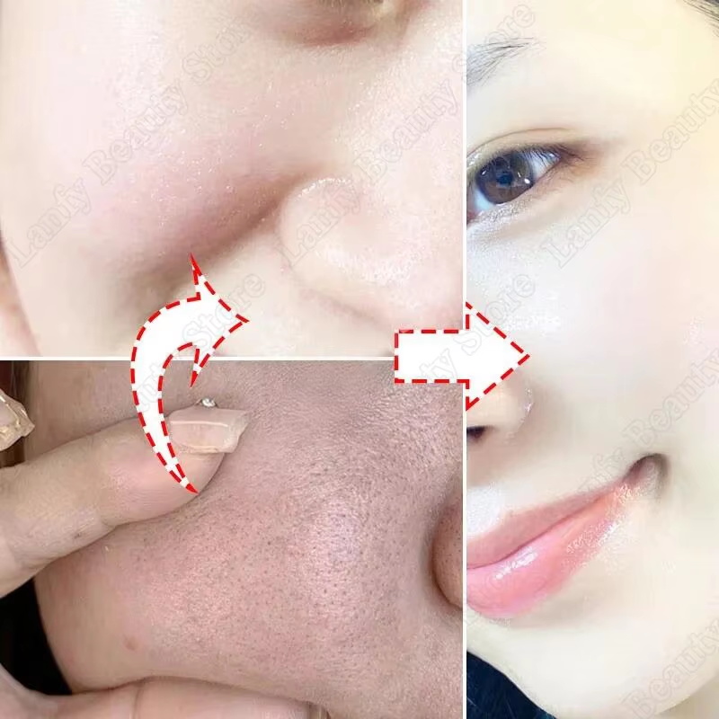 ครีมทำความสะอาดรูขุมขนกรดซาลิไ - Salicylic Acid Blackhead Remover บทวิจารณ์และราคา