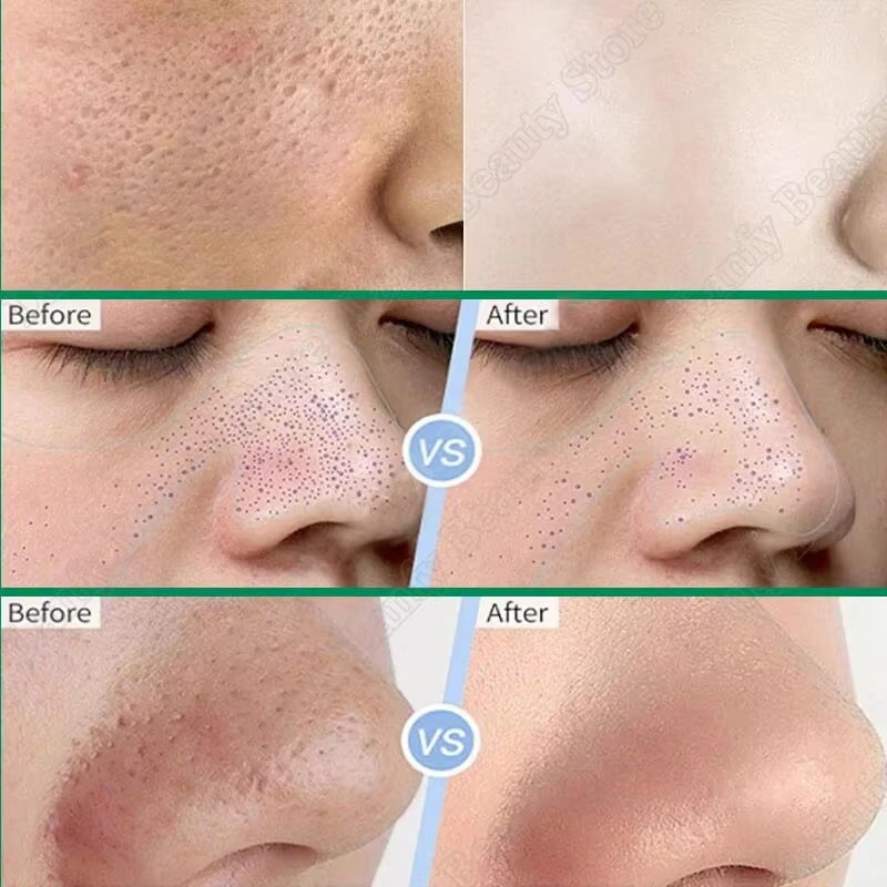 ครีมทำความสะอาดรูขุมขนกรดซาลิไ - Salicylic Acid Blackhead Remover บทวิจารณ์และราคา